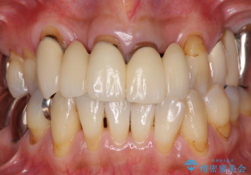 空気が抜けて話しにくい前歯のブリッジの作り直し オールセラミックブリッジにて審美的に仕上げるの治療前