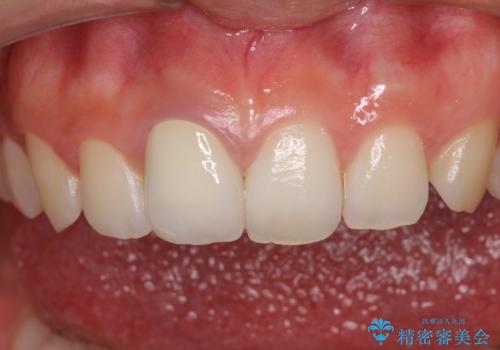 ぶつけて変色した前歯 オーダーメイドタイプのオールセラミッククラウンの治療後