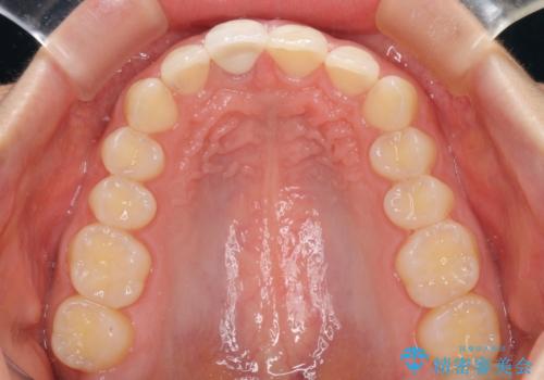 ぶつけて変色した前歯 オーダーメイドタイプのオールセラミッククラウンの治療後