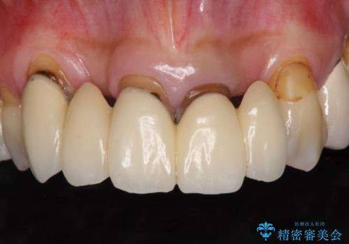 空気が抜けて話しにくい前歯のブリッジの作り直し オールセラミックブリッジにて審美的に仕上げるの症例 治療前