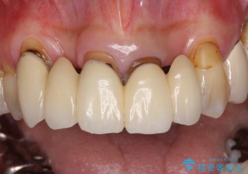 空気が抜けて話しにくい前歯のブリッジの作り直し オールセラミックブリッジにて審美的に仕上げるの治療前