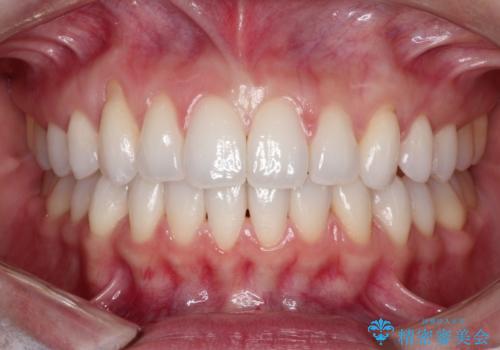 八重歯をマウスピース矯正で治療し、レーザーホワイトニングを行った症例の症例 治療後