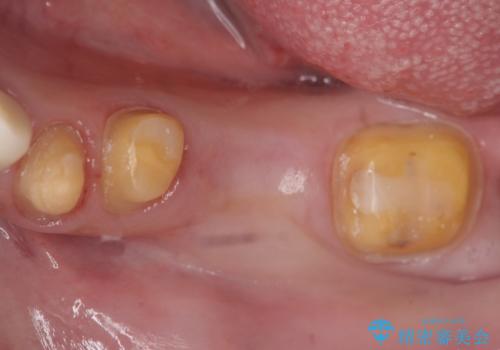 オールセラミッククラウン 銀歯を白い歯への治療中