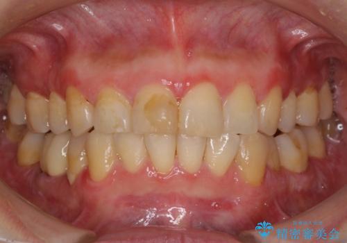 昔ぶつけた前歯 つめもの変色の治療前