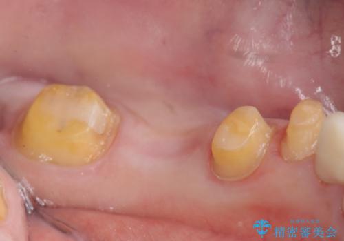 オールセラミッククラウン 銀歯を白い歯への治療中
