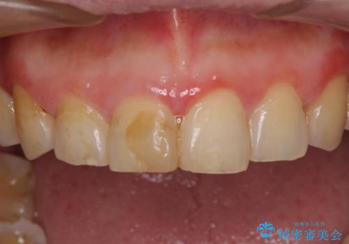 昔ぶつけた前歯 つめもの変色の症例 治療前