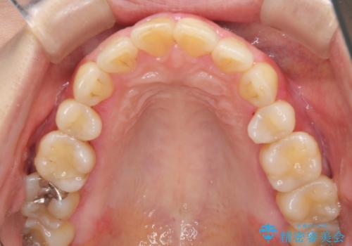 昔ぶつけた前歯 つめもの変色の治療前