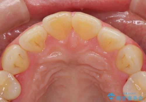 昔ぶつけた前歯 つめもの変色の治療前