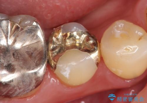 PGA(ゴールド)インレー　しみる歯の治療の症例 治療後