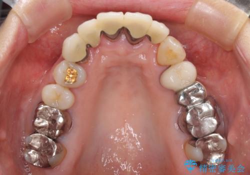 空気が抜けて話しにくい前歯のブリッジの作り直し オールセラミックブリッジにて審美的に仕上げるの治療前