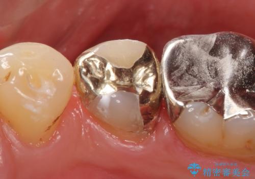 PGA(ゴールド)インレー　しみる歯の治療の治療後
