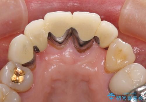 空気が抜けて話しにくい前歯のブリッジの作り直し オールセラミックブリッジにて審美的に仕上げるの治療前