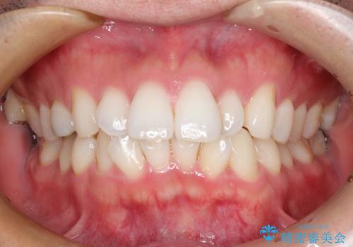 フルリンガル矯正　非抜歯でガタつきを整えるの症例 治療前
