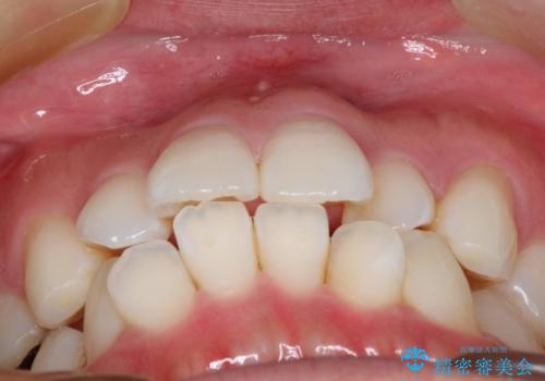 フルリンガル矯正 非抜歯でガタつきを整えるの治療前