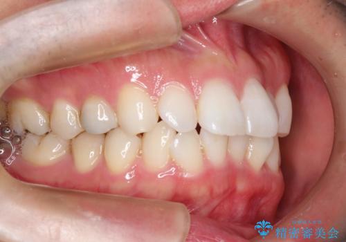 フルリンガル矯正 非抜歯でガタつきを整えるの治療前