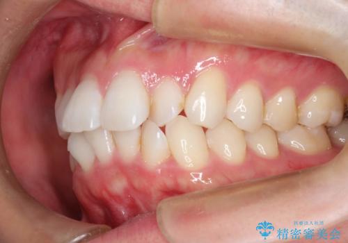 フルリンガル矯正 非抜歯でガタつきを整えるの治療前