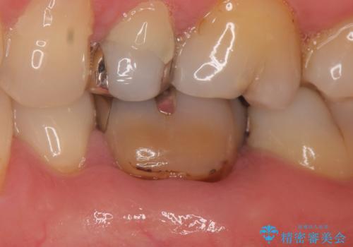 オールセラミッククラウン 根管治療後の補綴の治療前