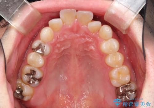 フルリンガル矯正 非抜歯でガタつきを整えるの治療前