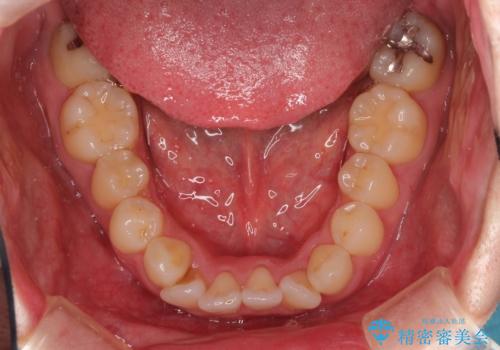 フルリンガル矯正 非抜歯でガタつきを整えるの治療前