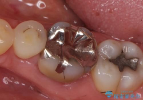 オールセラミッククラウン 根管治療後の補綴の治療前