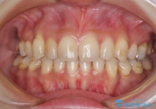 軽度な歯列不正 インビザライン・ライトによる矯正治療の治療中