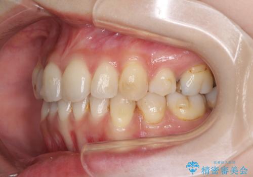 軽度な歯列不正 インビザライン・ライトによる矯正治療の治療中
