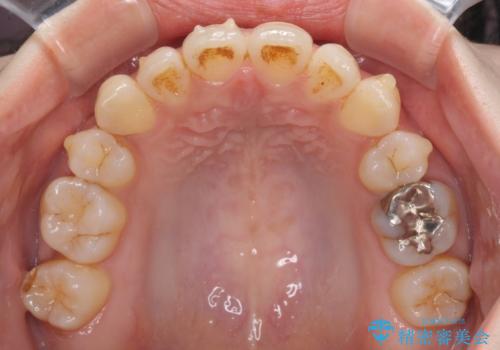軽度な歯列不正 インビザライン・ライトによる矯正治療の治療中