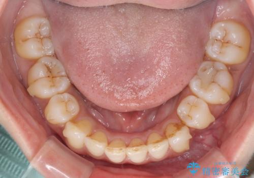 軽度な歯列不正 インビザライン・ライトによる矯正治療の治療中