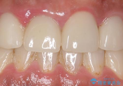 オールセラミッククラウン 土台ごと外れた前歯の補綴の治療前