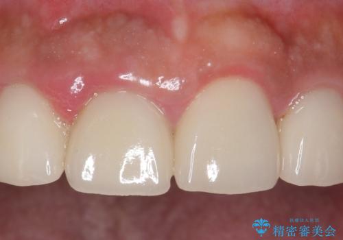 オールセラミッククラウン 土台ごと外れた前歯の補綴の症例 治療前