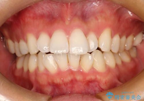 フルリンガル矯正 非抜歯でガタつきを整えるの治療中
