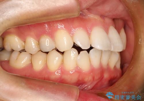 フルリンガル矯正 非抜歯でガタつきを整えるの治療中