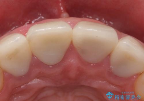 オールセラミッククラウン 土台ごと外れた前歯の補綴の治療前