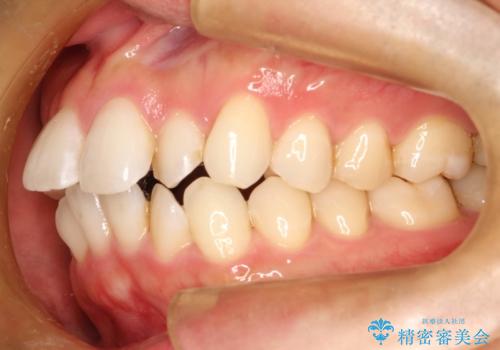 フルリンガル矯正 非抜歯でガタつきを整えるの治療中