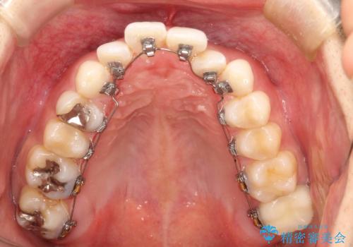 フルリンガル矯正 非抜歯でガタつきを整えるの治療中