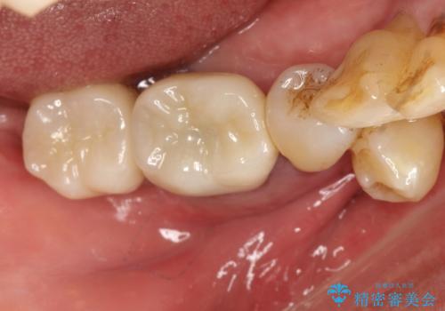 歯周病にて保存不可能な歯をショートインプラントで回復するの症例 治療後