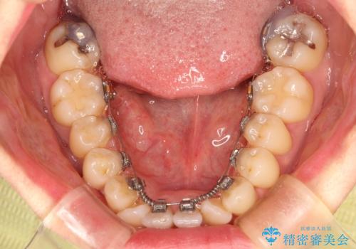 フルリンガル矯正 非抜歯でガタつきを整えるの治療中