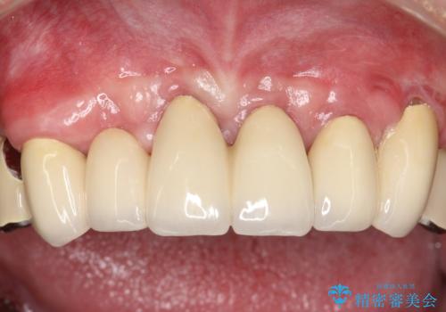 歯周病におかされた前歯の再建治療の治療後