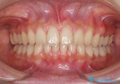 インビザラインによるディープバイトの改善の治療中