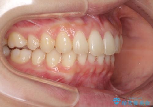 インビザラインによるディープバイトの改善の治療中