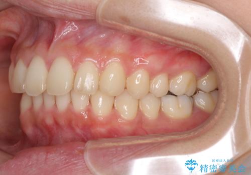 インビザラインによるディープバイトの改善の治療中