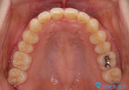 インビザラインによるディープバイトの改善の治療中