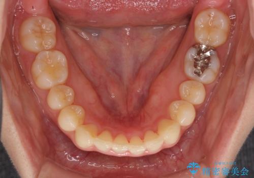 インビザラインによるディープバイトの改善の治療中