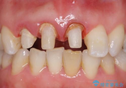 オールセラミッククラウン(スペシャル) 不揃いな前歯を美しくの治療中