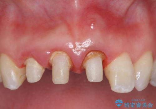 オールセラミッククラウン(スペシャル) 不揃いな前歯を美しくの治療中