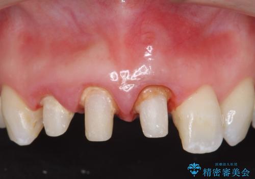 オールセラミッククラウン(スペシャル) 不揃いな前歯を美しくの治療中