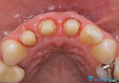 オールセラミッククラウン(スペシャル) 不揃いな前歯を美しくの治療中