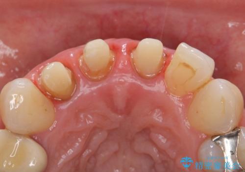 オールセラミッククラウン(スペシャル) 不揃いな前歯を美しくの治療中