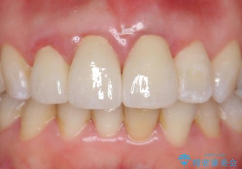 オールセラミッククラウン(スペシャル) 不揃いな前歯を美しくの治療後