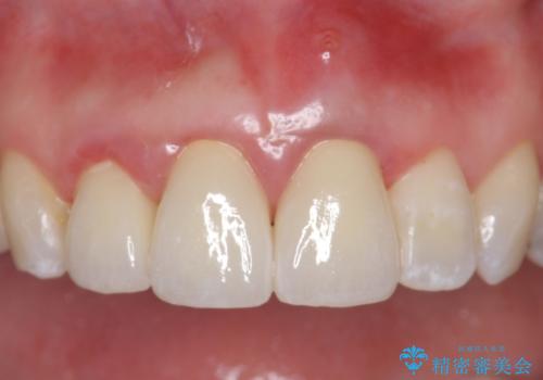 オールセラミッククラウン(スペシャル) 不揃いな前歯を美しくの症例 治療後